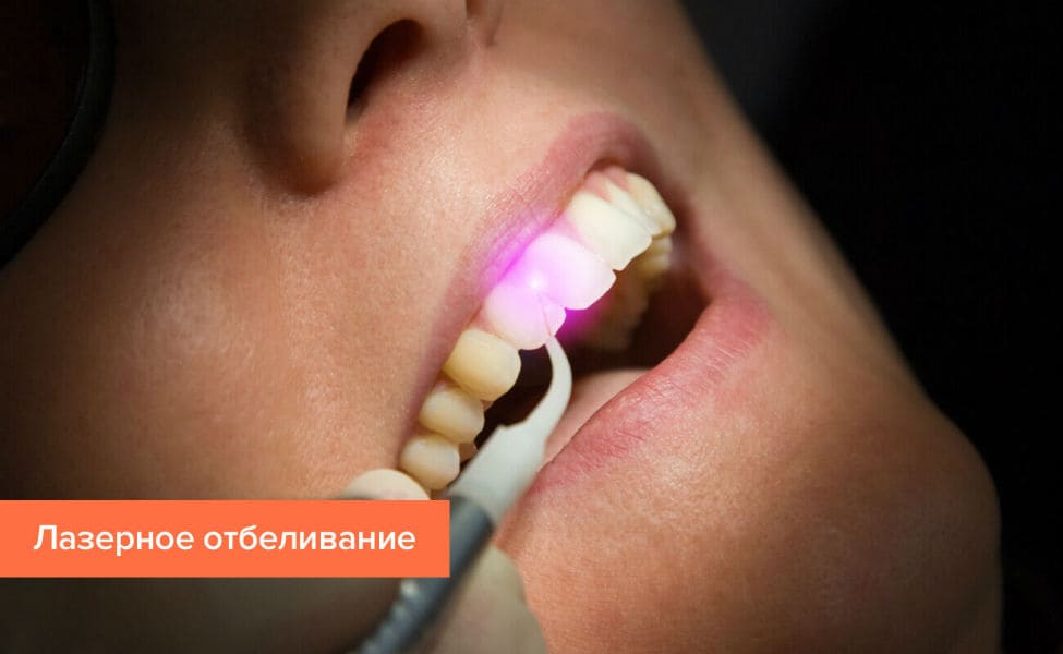 Лазерне відбілювання зубів в Києві - стоматологія Фортуна-Дент